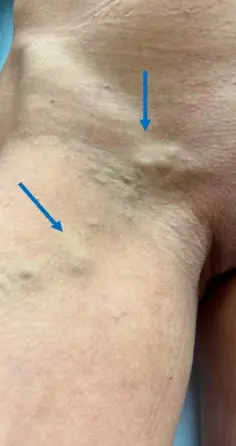 szeméremtáji varix