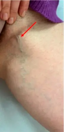 szeméremtáji varix3