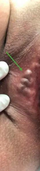 Szeméremtáji visszerek